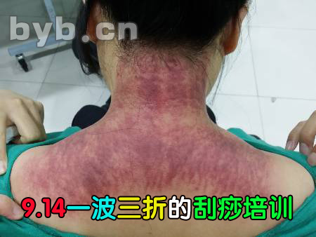 byb.cn 刮痧培訓(xùn)